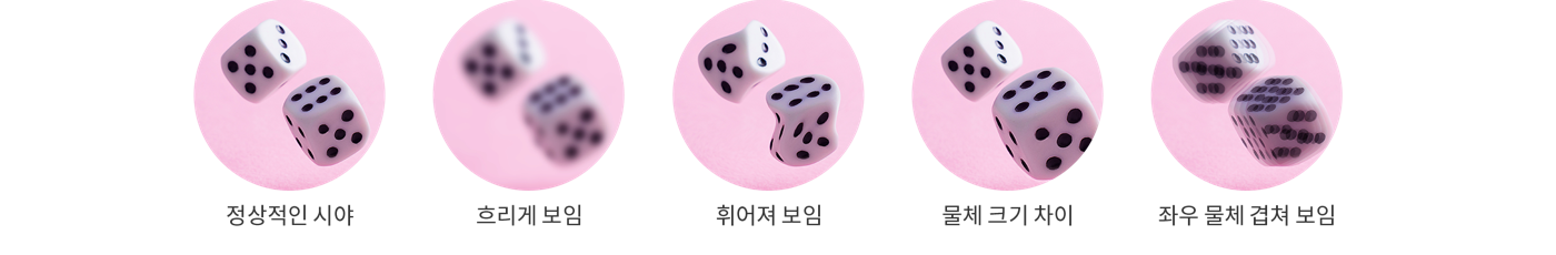 망막전막 증상 비교 그림: 정상적인 시야, 흐리게 보임, 휘어져 보임, 물체 크기 차이, 좌우 물체 겹쳐 보임