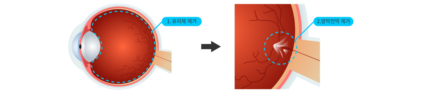 망막전막 수술 과정 그림: 1단계 유리체 제거, 2단계 망막전막 제거