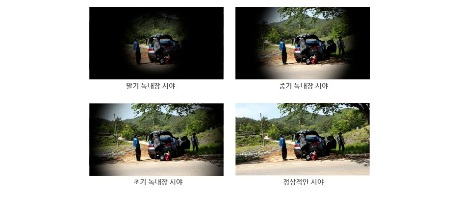 녹내장 진행에 따른 시야 변화 사진 4장: 정상적인 시야, 주변부가 어두워진 초기 녹내장 시야, 시야가 더 좁아진 중기 녹내장 시야, 가운데만 보이는 말기 녹내장 시야