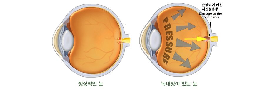 정상적인 눈과 녹내장이 있는 눈 비교 그림. 녹내장이 있는 눈은 안압이 높아져 시신경유두가 손상되고 커져 있음